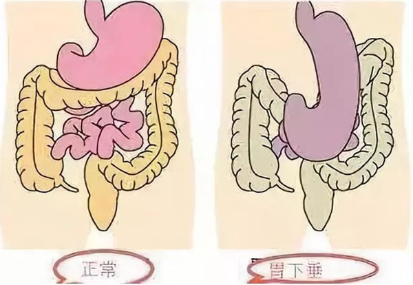 胃下垂吃什么中成药?饮食有哪些注意事项?