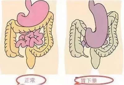 胃下垂吃什么中成药?饮食有哪些注意事项?