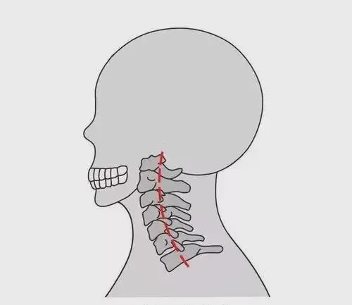 颈椎生理曲度反弓原因有哪些？